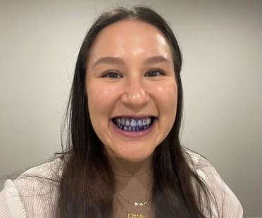 Customer photo review of Dentéa™ V34 — Blanqueamiento Dental en Casa
