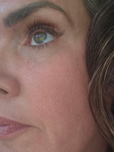 Customer's smooth skin after using the Seranova Micro Infusion System, showing a clear complexion.