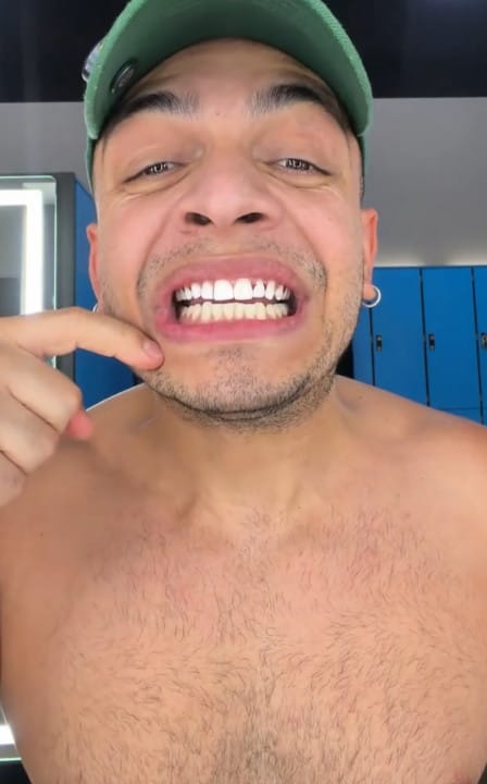 Customer photo review of Dentéa™ V34 — Blanqueamiento Dental en Casa