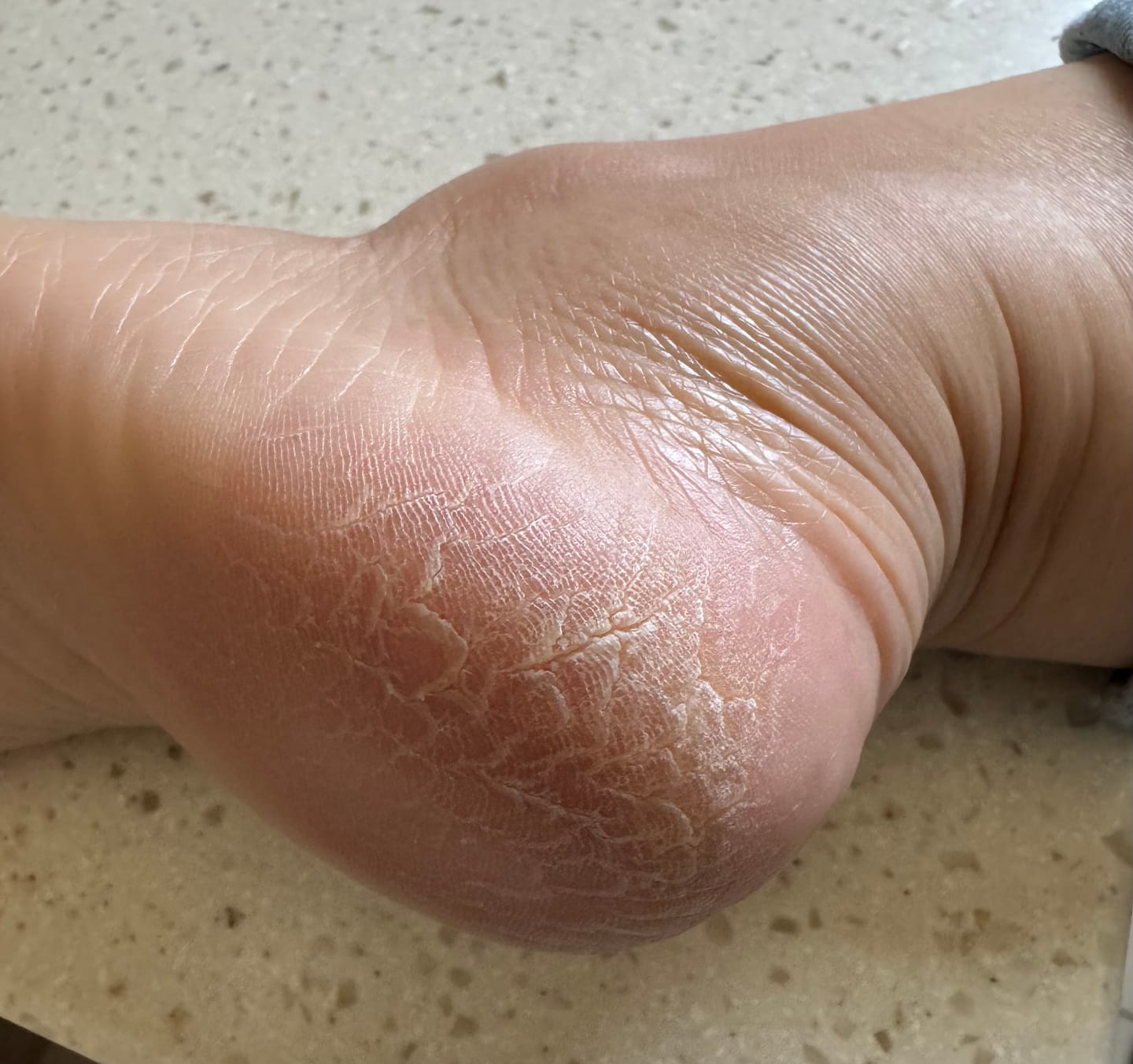 Customer photo review of Foot Balm