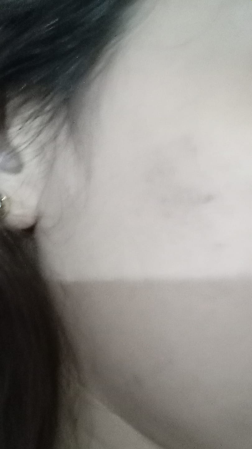 Customer photo review of Clear Veda Anti Pigmentation Cream