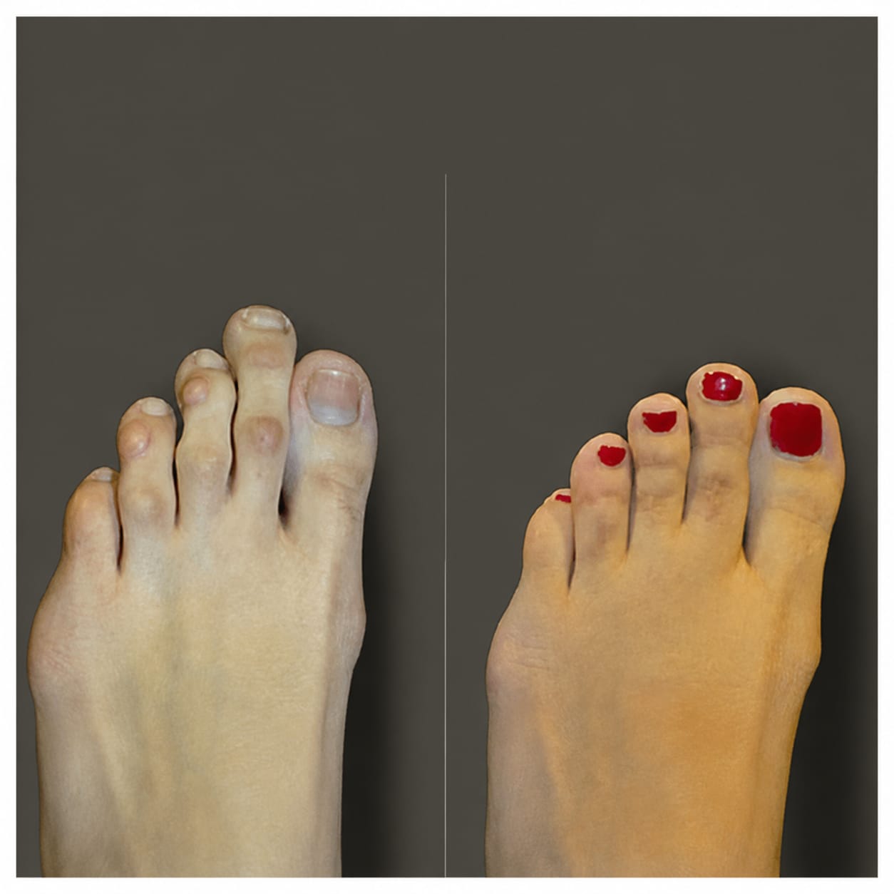 Customer photo review of NAYORI 3-in-1 Toe Support