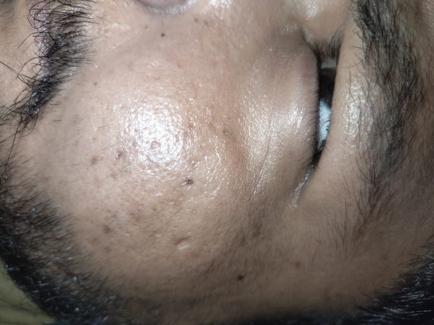 Customer photo review of MandelAC Facewash