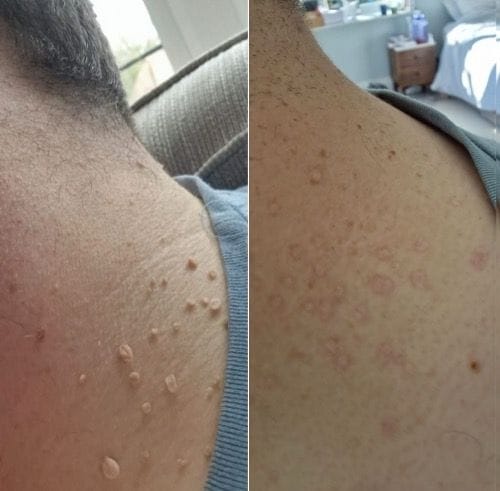 Customer photo review of 7- Day Skin Tag Clear