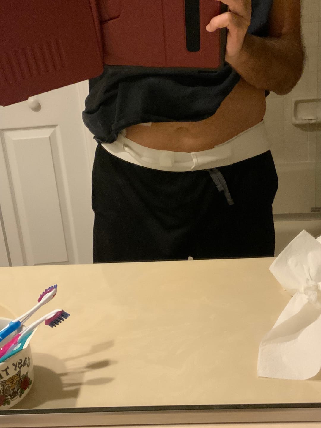 Customer photo review of Peritoneal Dialysis Belt (Individual)