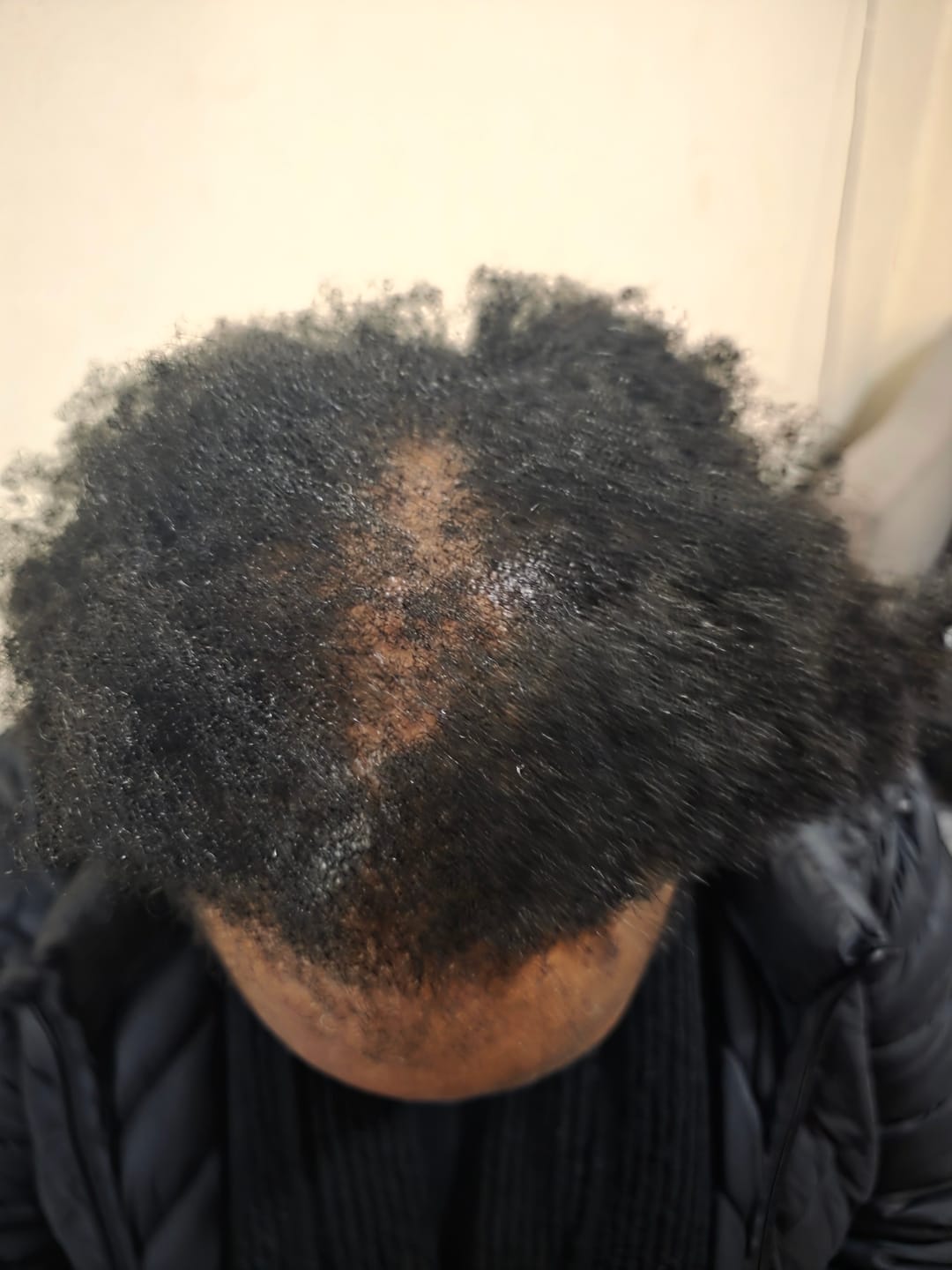 Customer photo review of Newtrino Hair Loss Capsules for Women - Nutrient-Rich Support 60 Capsules
