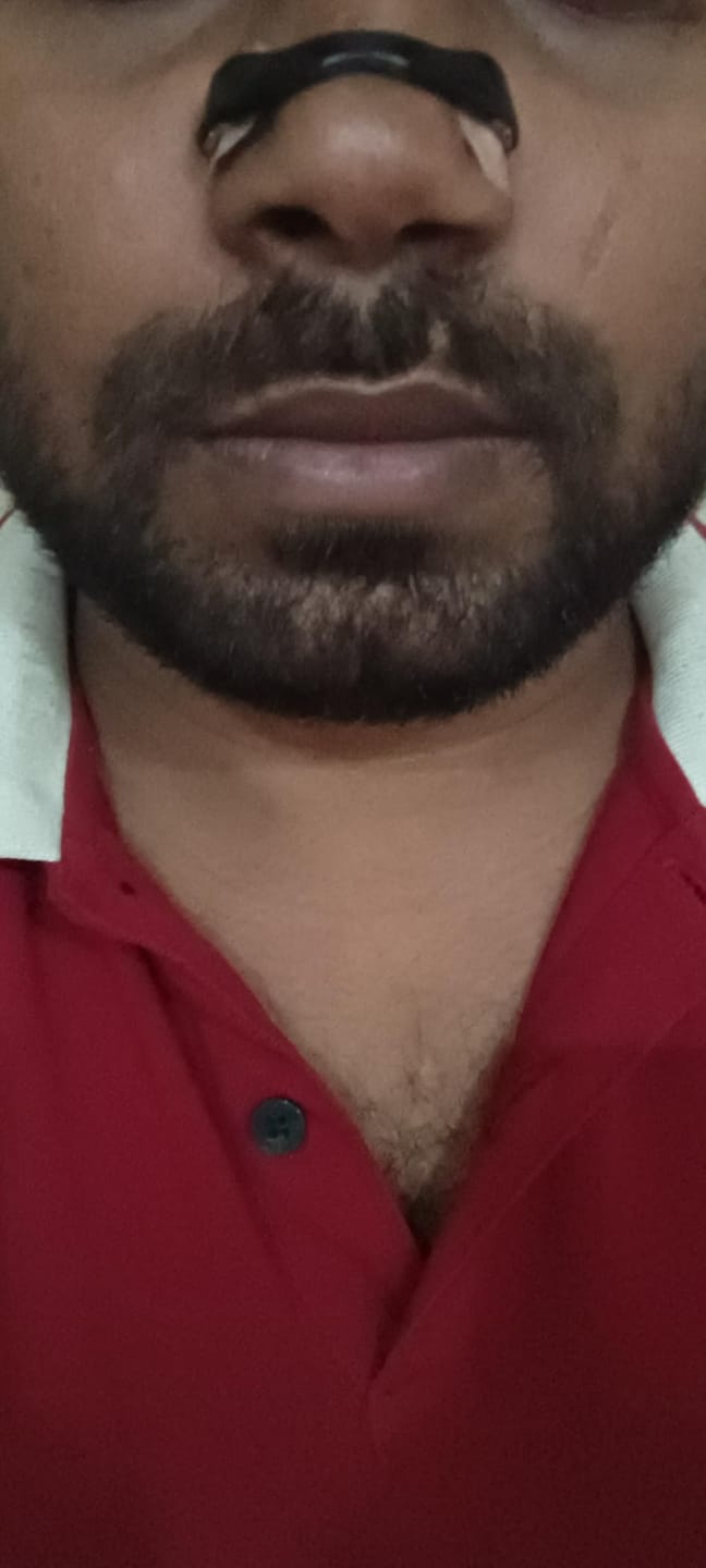 Customer photo review of Magnetic Nasal Strips