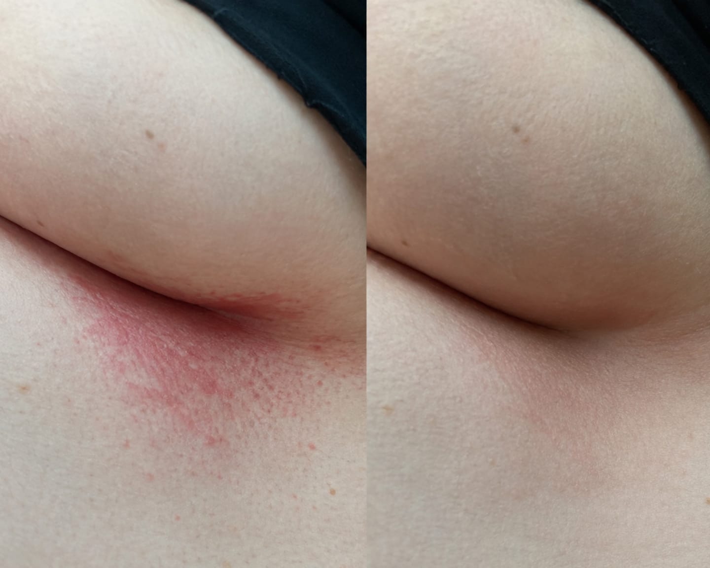 Customer photo review of Jabón de Tea Tree para la Comezón debajo del Busto