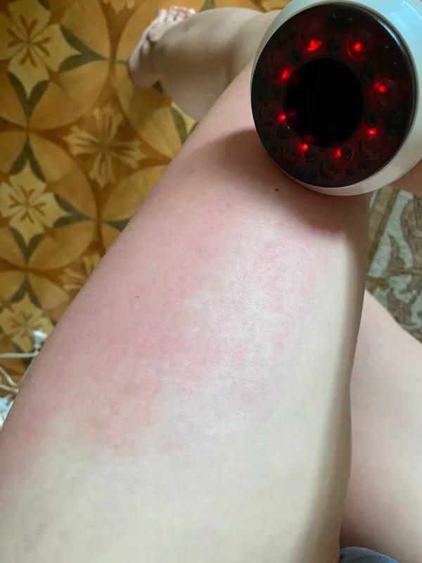 Customer photo review of Revimus Anti-Cellulite Massager