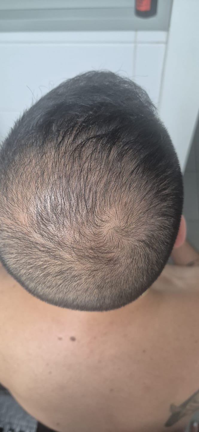 Customer photo review of RootFix™ | ערכה לטיפול בנשירה והתקרחות של השיער