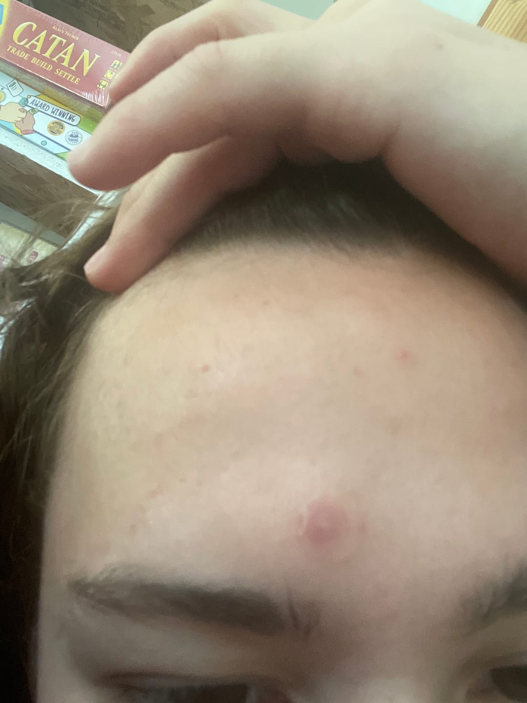 Customer photo review of The Complete Acne Killer System 2.0