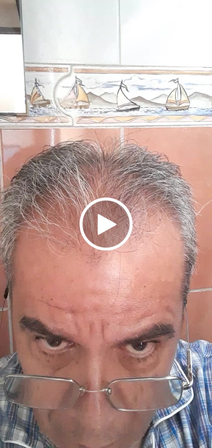 Customer video review of Minoxidil 5 mg con 90 tabletas para 3 meses de tratamiento