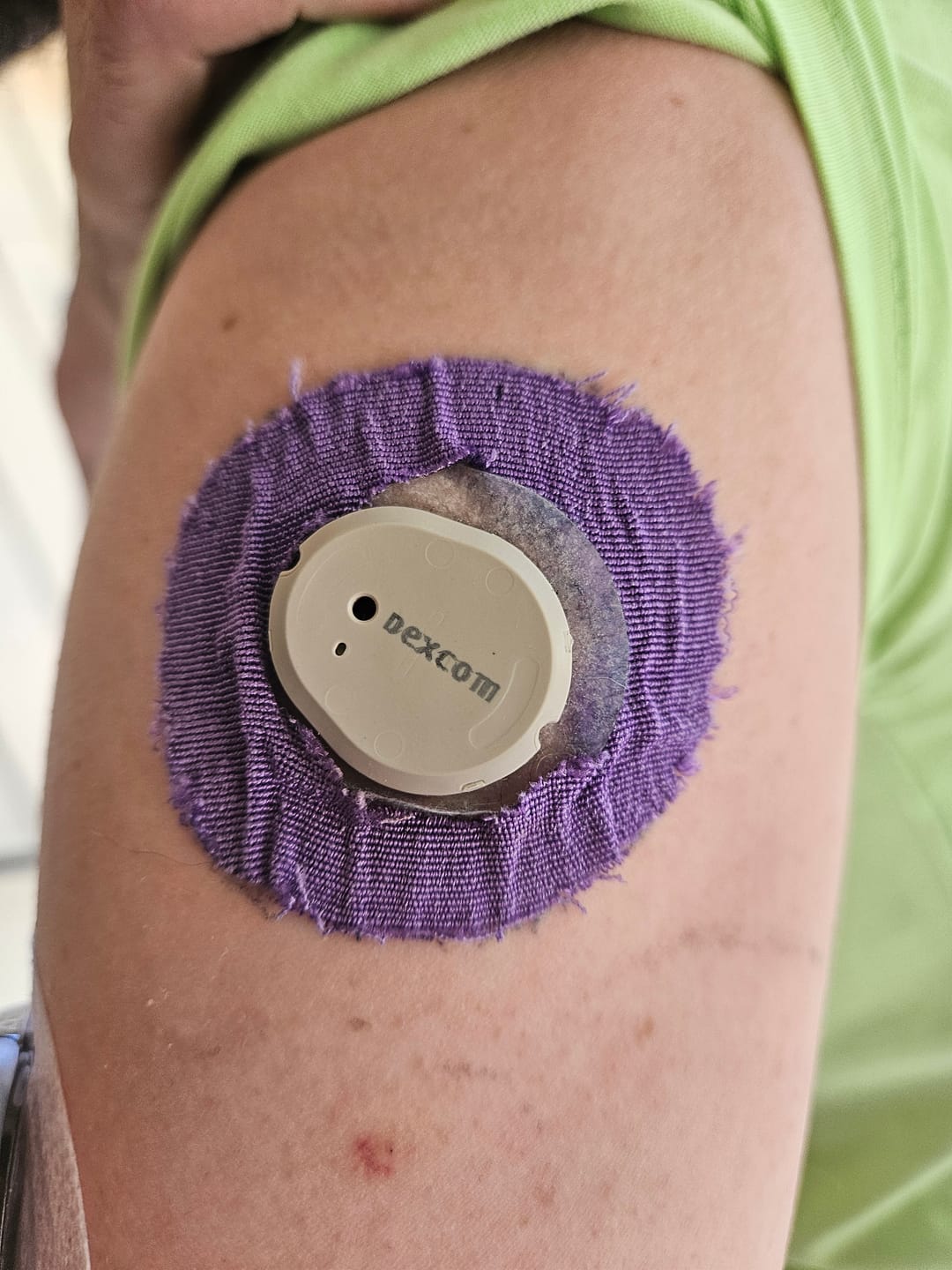 Customer photo review of Skin Grip Original - Dexcom G7 & Stelo Adhesive Patches (With Cutout)