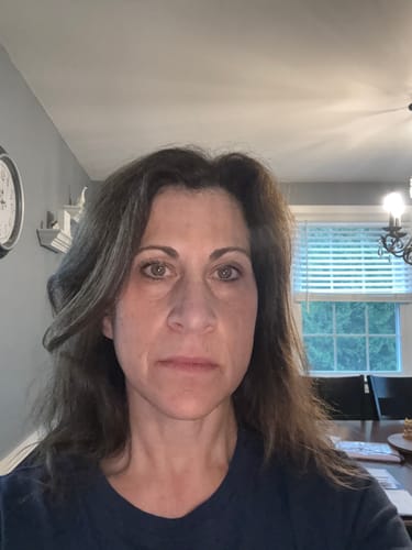 Customer's face after four treatments with the Micro Infusion System, showing smoother skin texture.