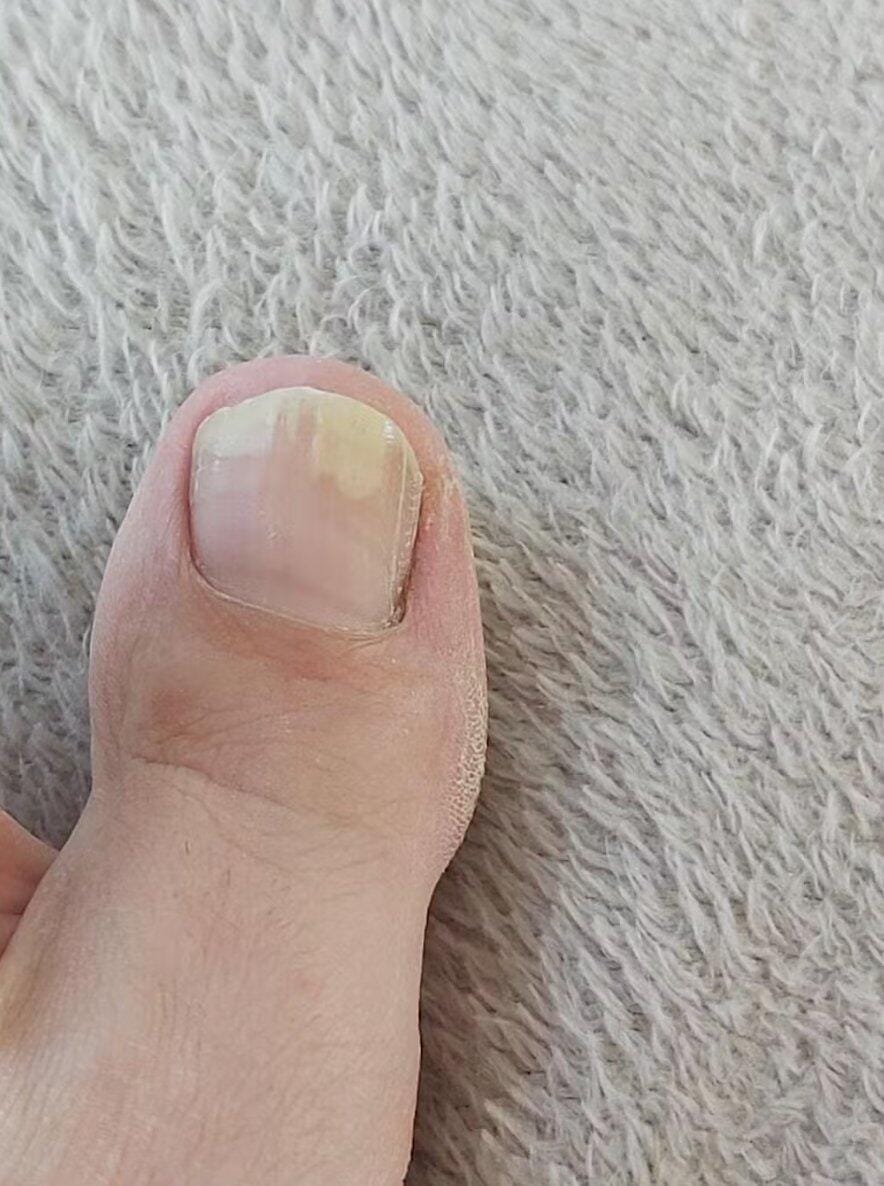 Customer photo review of Appareil Lumière Bleue Anti-Mycose des Ongles