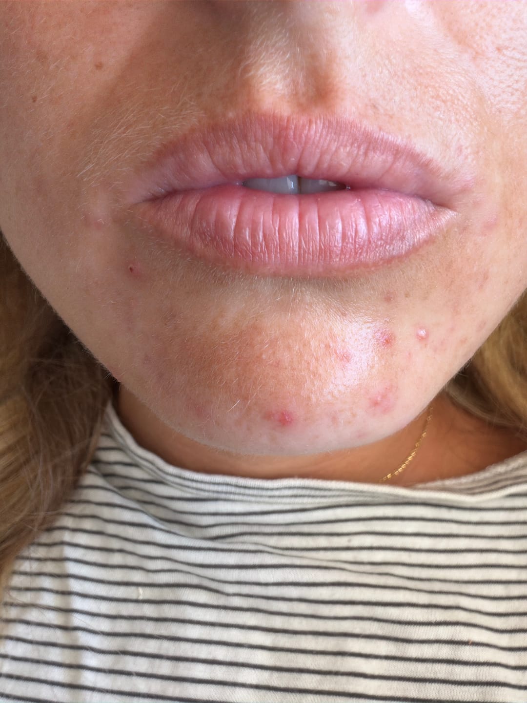 Customer photo review of A CONTROL - ACNÉ HORMONAL & RESISTENCIA A LA INSULINA