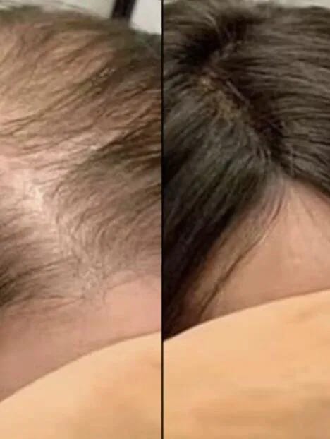 Customer photo review of ¿Poco cabello o poco volumen en la parte superior?