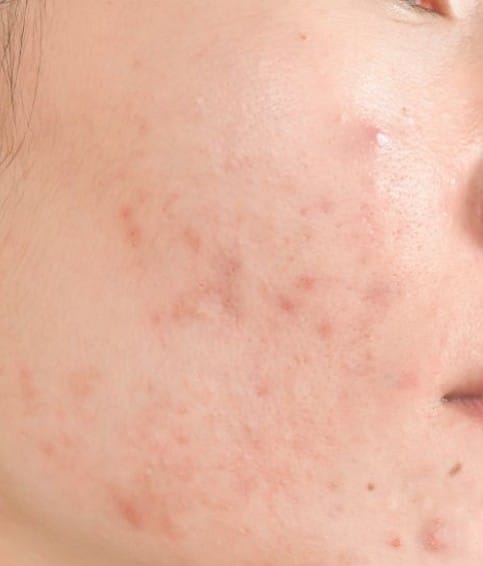Customer photo review of Clarevo Anti Acne Soap