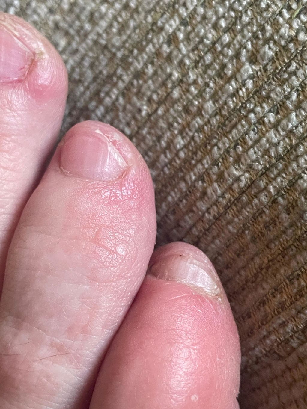 Customer photo review of Appareil Lumière Bleue Anti-Mycose des Ongles