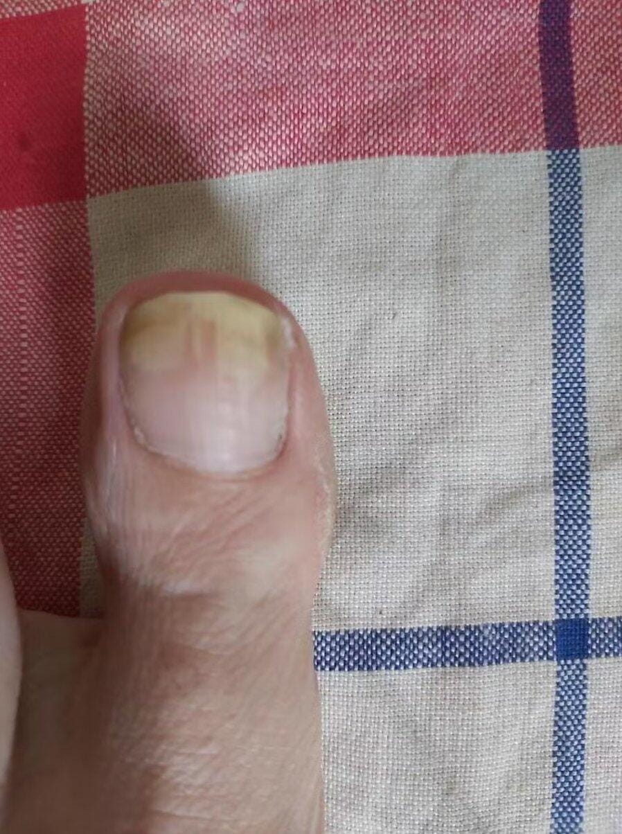 Customer photo review of Appareil Lumière Bleue Anti-Mycose des Ongles