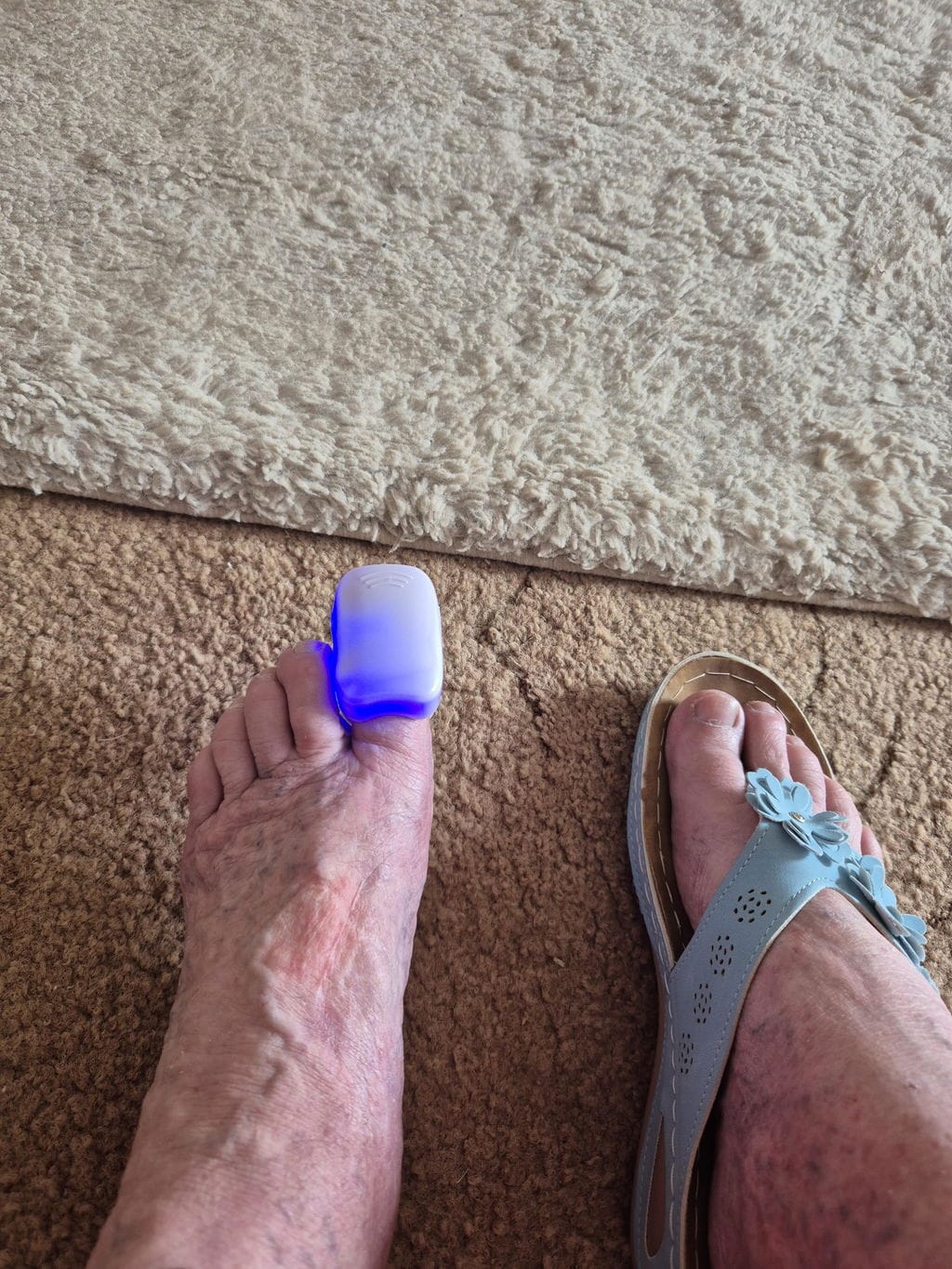Customer photo review of Appareil Lumière Bleue Anti-Mycose des Ongles