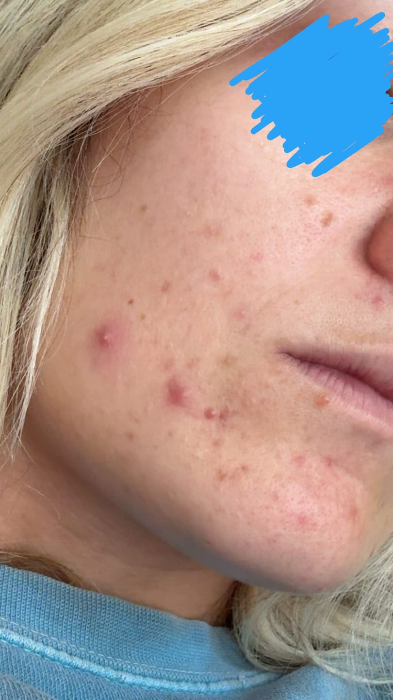 Customer photo review of Kill Acne & Redness Ritual