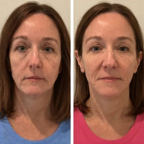 Customer photo review of The Lymphatic Contour Face Brush