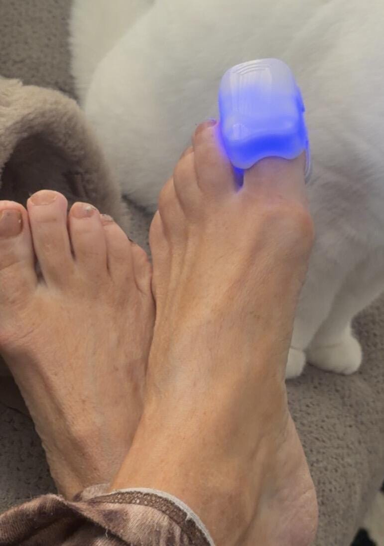 Customer photo review of Appareil Lumière Bleue Anti-Mycose des Ongles