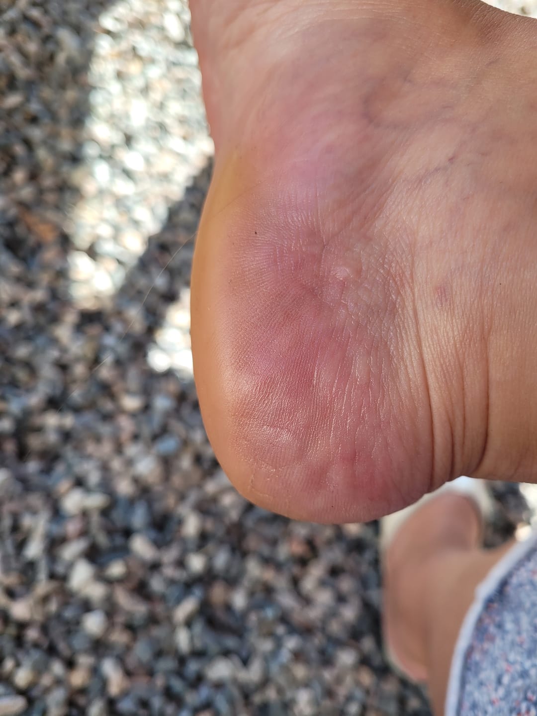 Customer photo review of 🍯 HoneyBalm™ – Baume Hydratant au Miel pour les pieds
