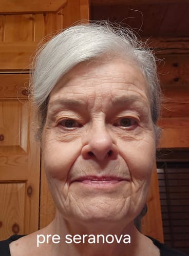 Reviewer's face before starting treatment with The Micro Infusion System.