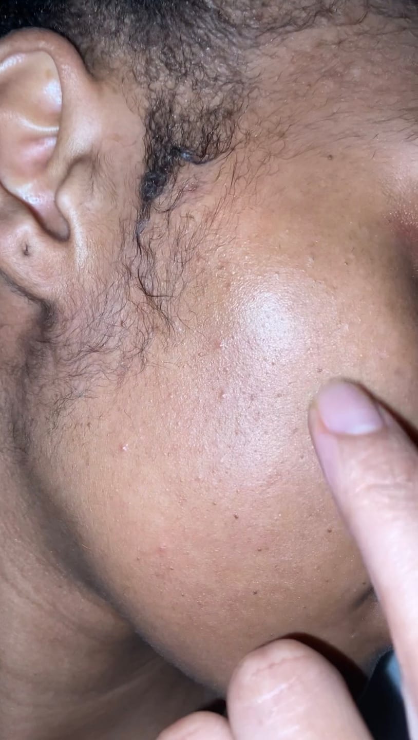 Customer photo review of Minoxidil REGULAR (2%) strength SOLUTION, 1 x 60ml pack