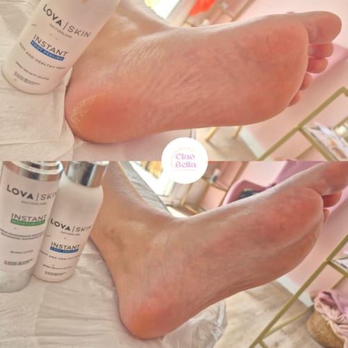Customer photo review of LOVASKIN Discovery Kit SPECIAL TV OFFER - Twice the treatments