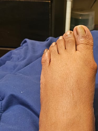 Customer's foot showing reduced curvature of the big toe after using Treatmedy Bunion Fix.