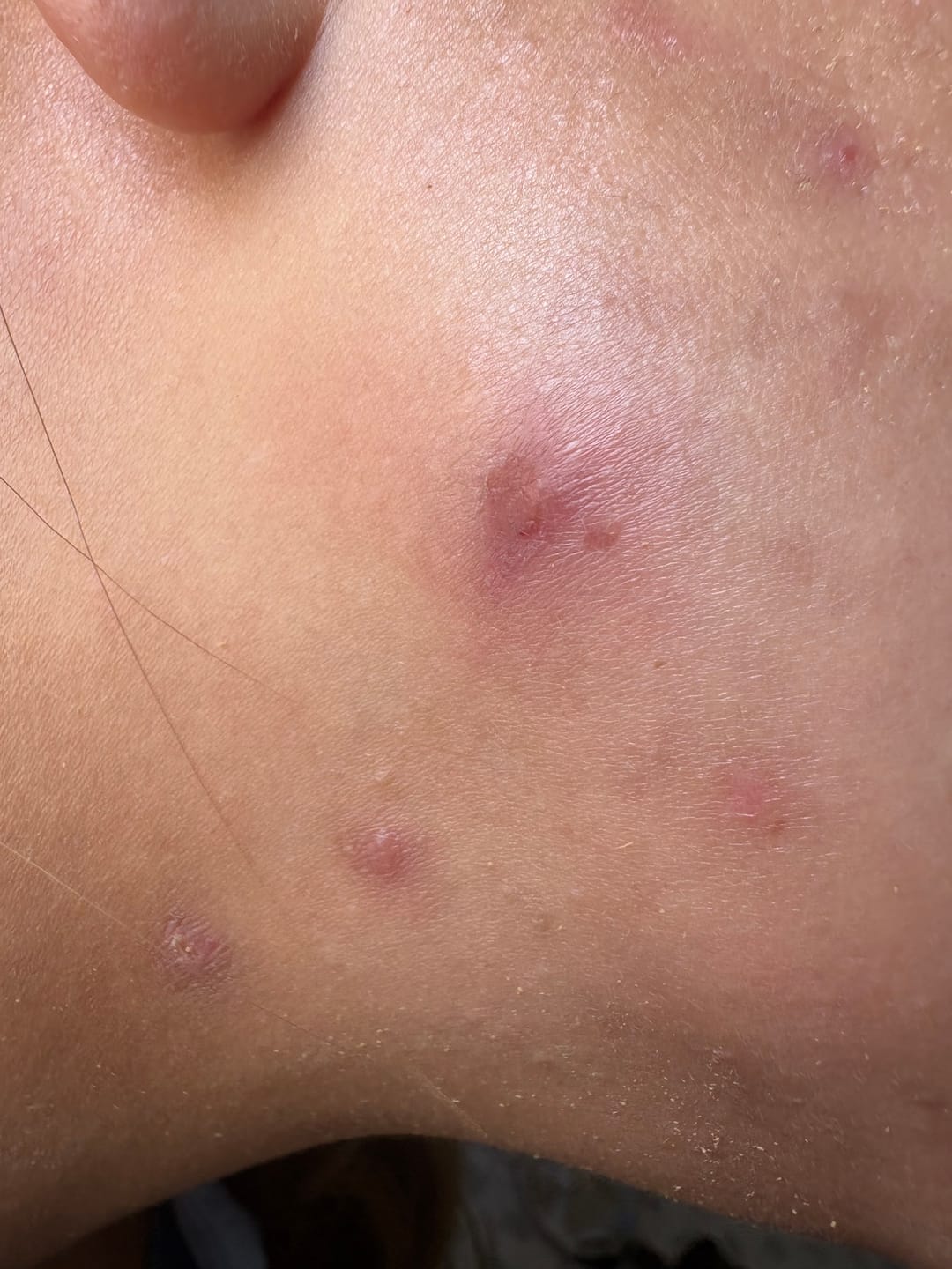 Customer photo review of A CONTROL - ACNÉ HORMONAL & RESISTENCIA A LA INSULINA