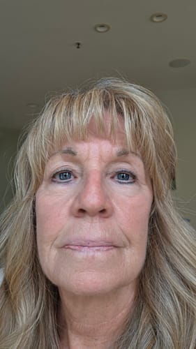 Customer's face after using Seranova Micro Infusion Patches, showing a refreshed and bright under-eye area.