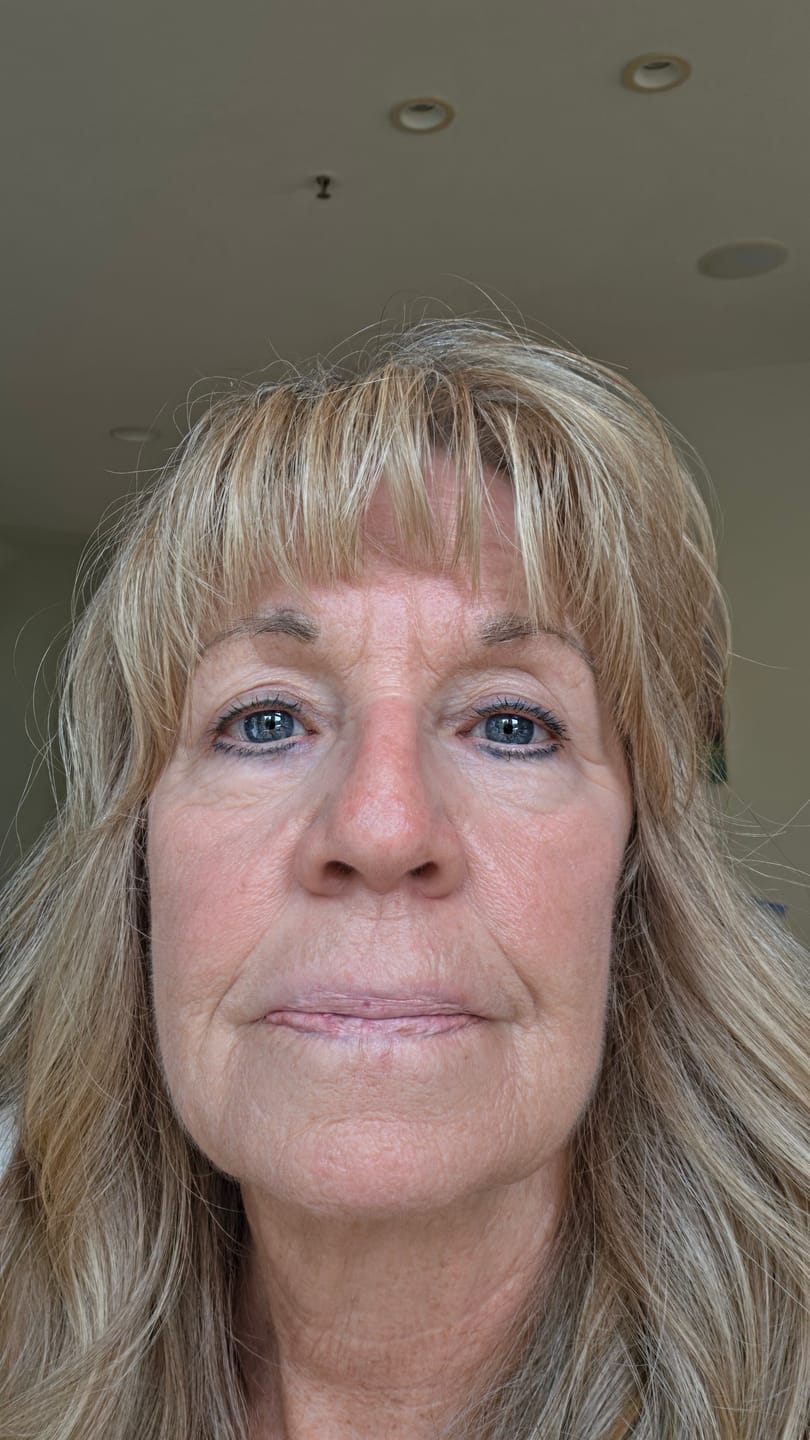 Customer photo review of Micro Infusion Patches