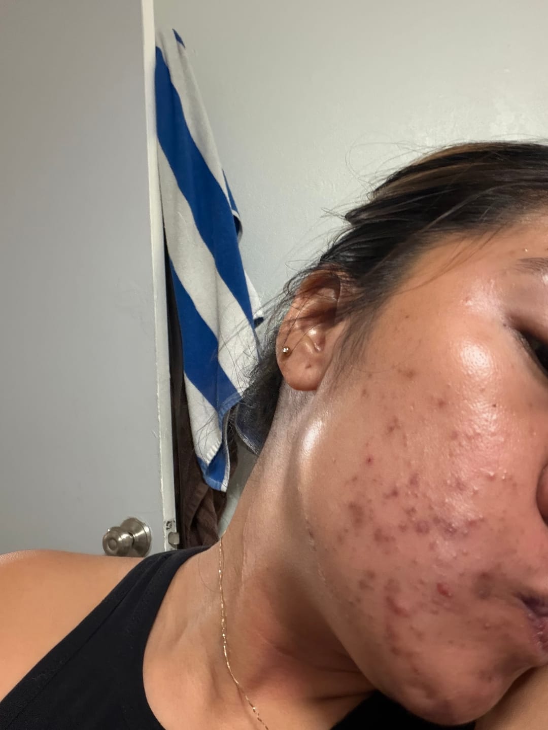 Customer photo review of BeautyPro 2.0 - High Frequency Wand