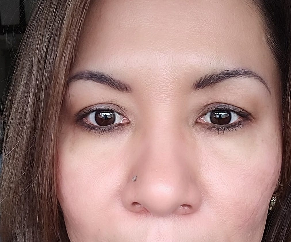 Customer photo review of INIA SPHERA At-Home Clinical-Grade RF, EMS & LED Rejuvenation Device