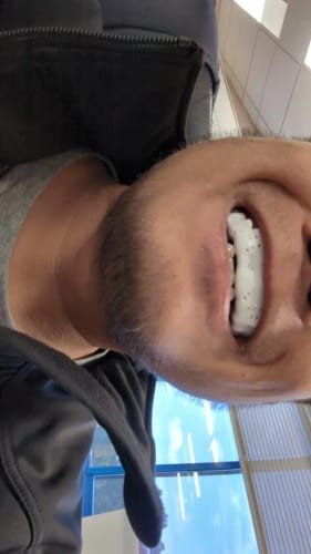 Customer photo review of Lunate Overnight Protection Mouth Guard