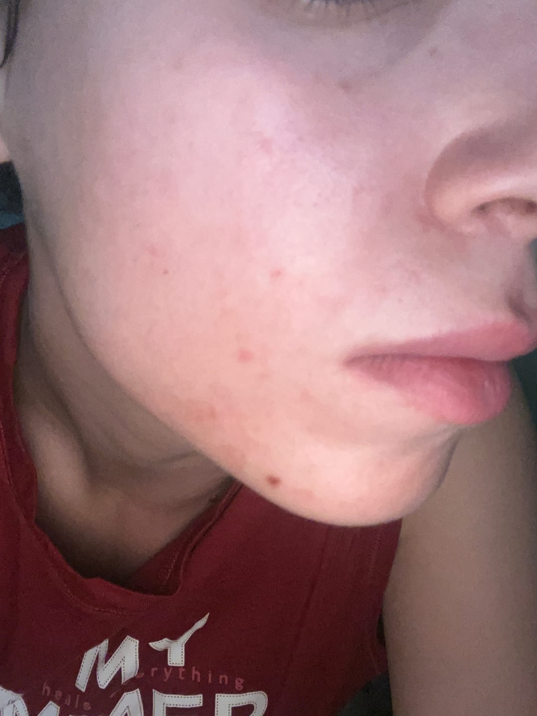 Customer photo review of A CONTROL - ACNÉ HORMONAL & RESISTENCIA A LA INSULINA