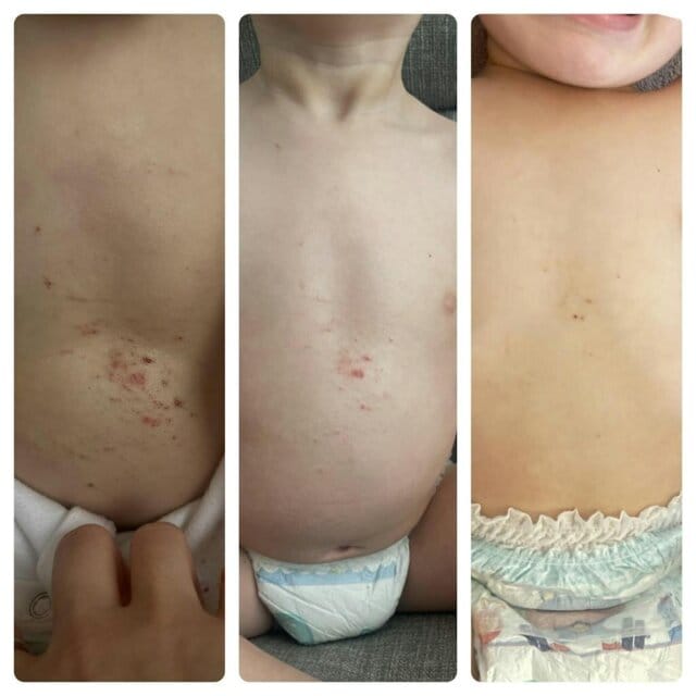 Customer photo review of Repair Balm For Eczema & Psoriasis