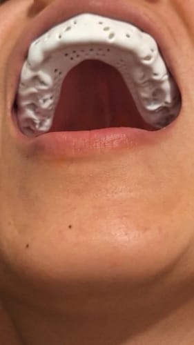 Customer photo review of Lunate Overnight Protection Mouth Guard
