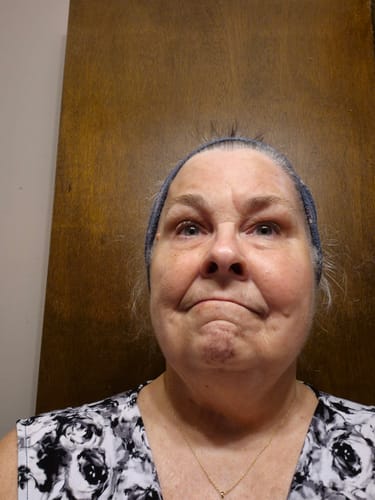 Customer's face after six weeks of using The Micro Infusion System.