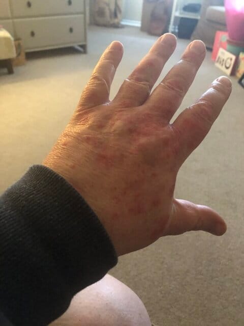 Customer photo review of Repair Balm For Eczema & Psoriasis
