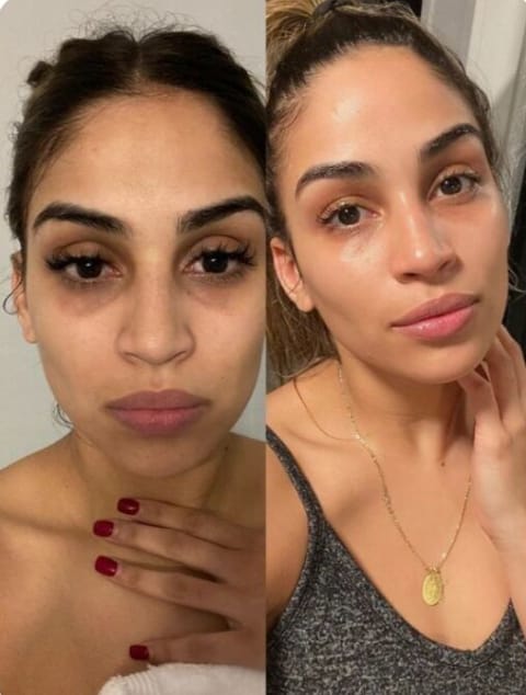 Customer photo review of Vivamu™ Kojik Asit & Zerdeçal Yüz Temizleme Pedi – 40 Adet