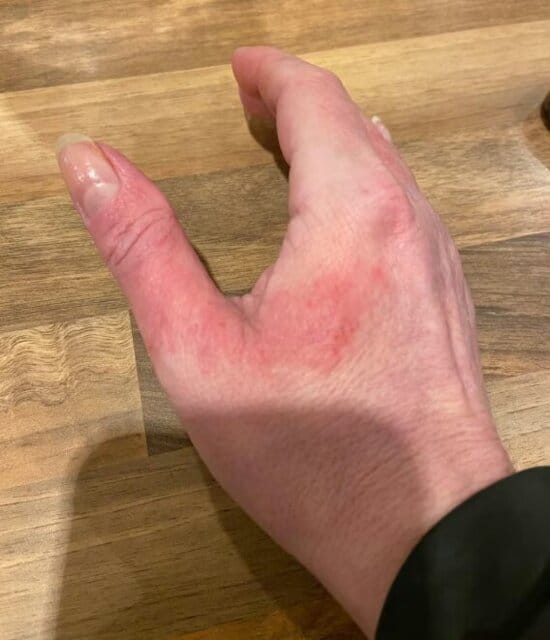 Customer photo review of Repair Balm For Eczema & Psoriasis