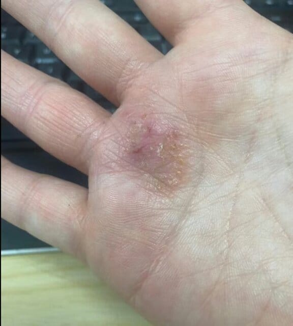 Customer photo review of Repair Balm For Eczema & Psoriasis