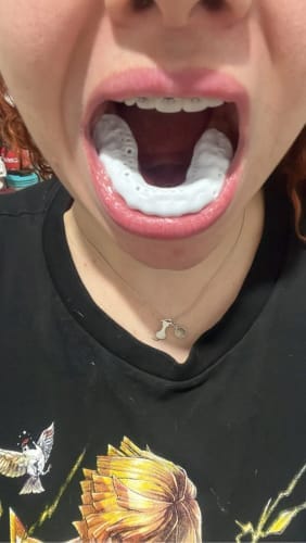 Customer photo review of Lunate Overnight Protection Mouth Guard