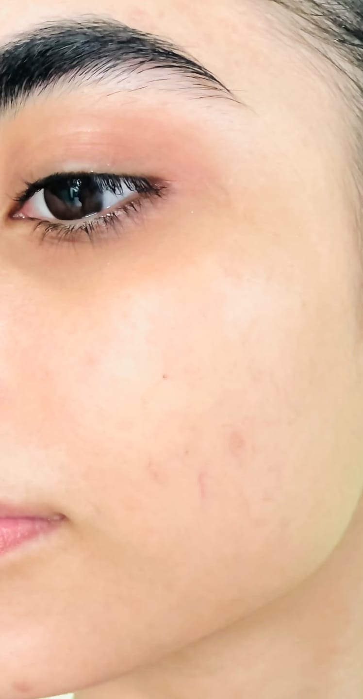 Customer photo review of MandelAC Facewash