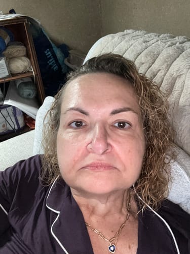 Customer's face showing skin texture improvement after using the Seranova Micro Infusion System.